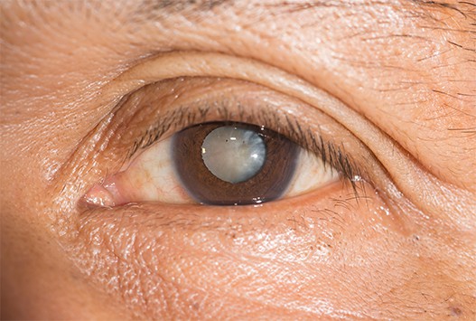 About Cataract Surgery